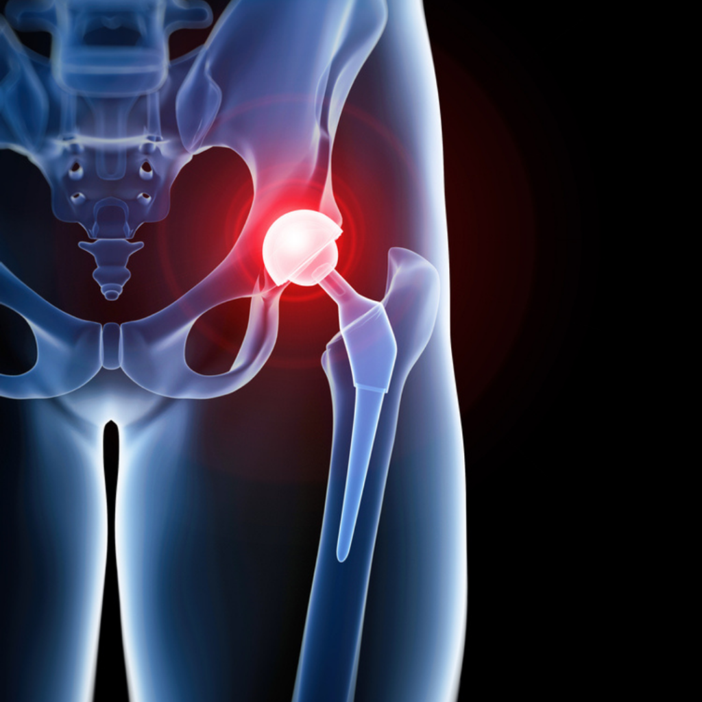 Best Hip Replacement Hospital in kapur