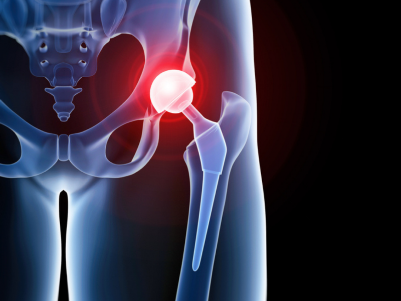 Best Hip Replacement Hospital in kapur